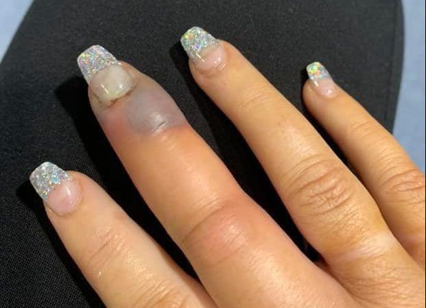 Mujer casi pierde un dedo en el salón de belleza tras manicure
