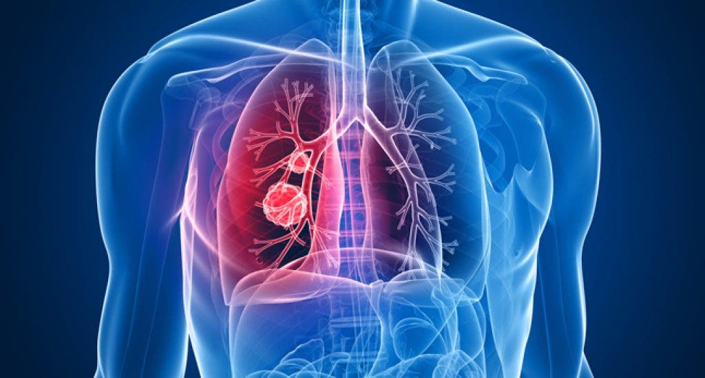 El 90 % de pacientes con cáncer de pulmón mueren debido a la detección tardía