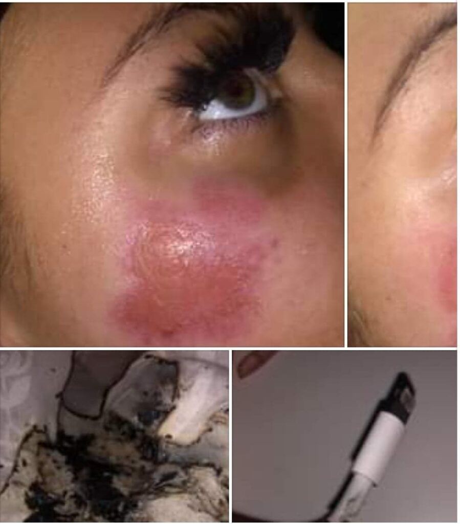 Un cargador de IPhone estalla y quema la cara a una joven mientras dormía en su cama.