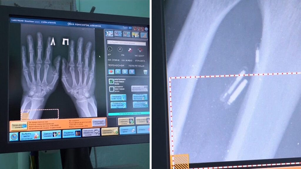 Un médico ruso se implanta 5 microchips en las manos para hacer su vida «más fácil»