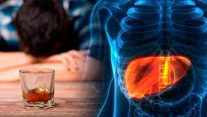 El alcohol el enemigo silente del hígado