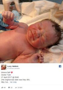 Bebé nace con anticonceptivo de la mamá en la mano