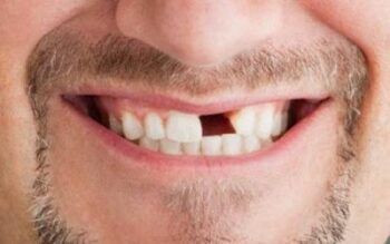 Estudiante rompe diente a profesor de una pedrada