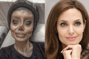 Se desfigura el rostro por quere parecerse a Angelina Jolie