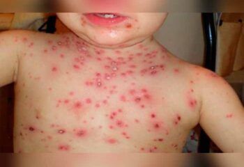 RD enfrenta nuevo brote de varicela, más de tres mil casos reportados.