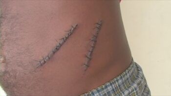 Conductor choca joven y luego le dio varias puñaladas y un balazo