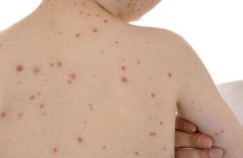 Unicef advierte sobre aumento «alarmante» del sarampión a nivel mundial