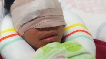 Joven que fue baleado en la cara durante atraco podría recuperar visión en un ojo