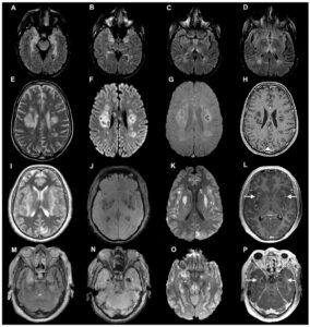 Coronavirus ataca al cerebro de este modo