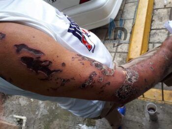 Así quedo el brazo del chófer que transportaba a Yocairi