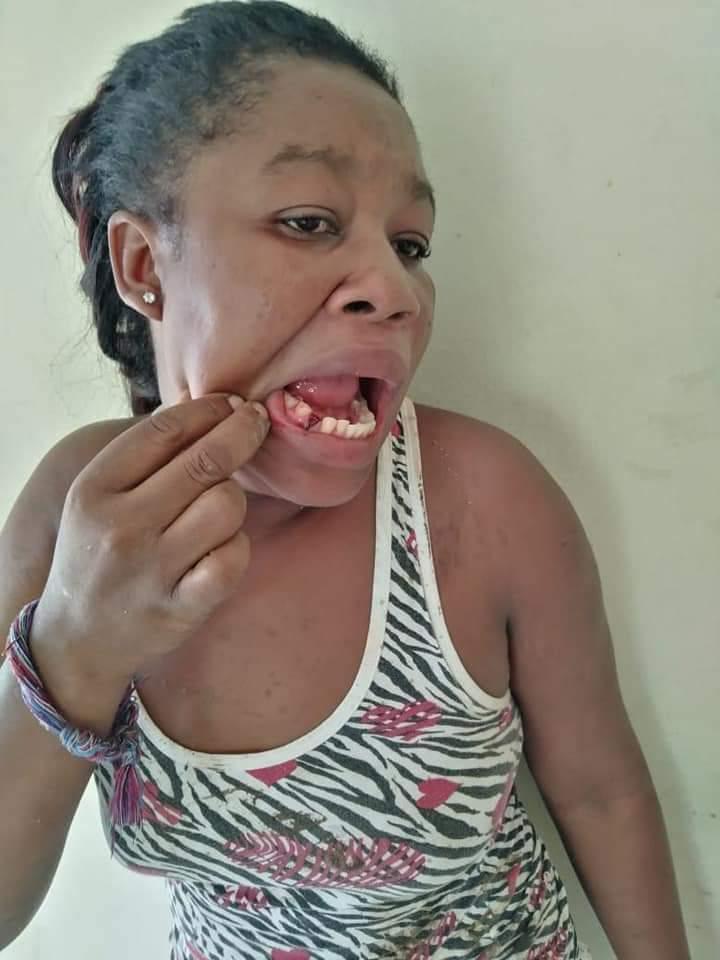 Por una jugada en la lotería le sacó un diente a su pareja en Barahona
