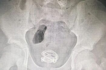 “Quería saber de donde venía la orina”. Niño de 13 años se introduce cable de 70 cm en el pene