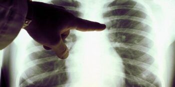 Hombre se cura de cáncer gracias al COVID-19