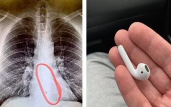 Hombre se trago un auricular mientras dormía