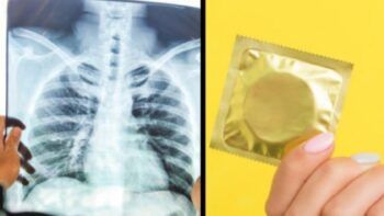 Fue al hospital para atenderse de tuberculosis y le encontraron un preservativo en los pulmones