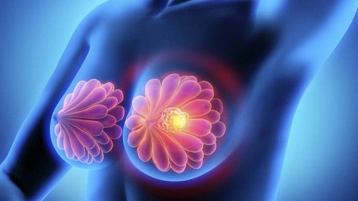Un gen de células que rodean los tumores, clave en avance del cáncer de mama