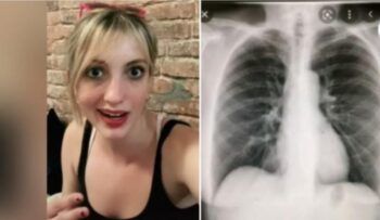 Fue al médico por una tos molesta y descubren que tiene el corazón del otro lado del pecho
