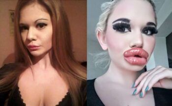 La mujer con los labios más grandes del mundo quiere seguir aumentándolos