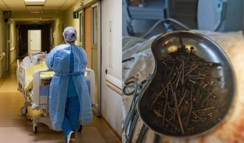 Extraen clavos y tornillos del estómago de un hombre