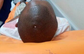 Hombre se clava un clavo en su cabeza porque “sentía su cerebro flojo”
