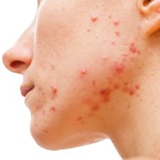 13 poderosos remedios caseros para el acné