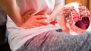 80% muertes por cáncer de colon se pueden evitar