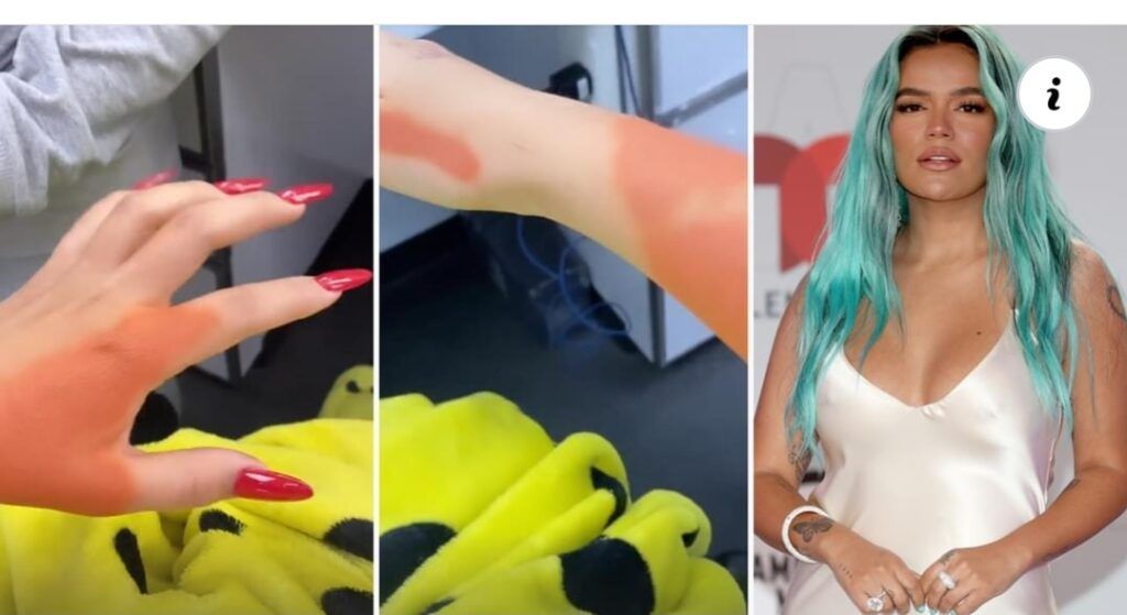 Karol G se borra tatuaje de Anuel