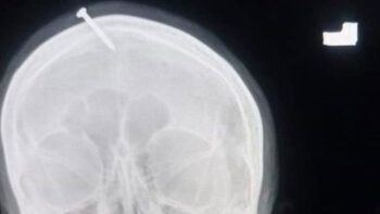 Le clavaron un clavo en la cabeza a una embarazada para que “tuviera un varón”