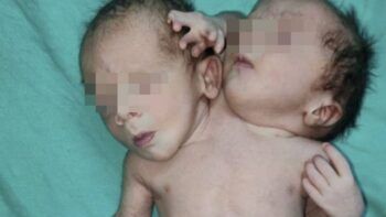 Embarazada de mellizos termina dando a luz a un bebé de dos cabezas