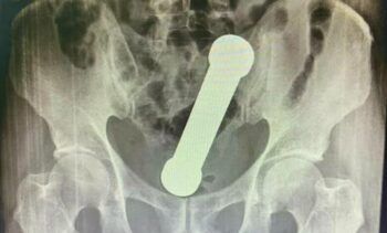 Hombre se introduce mancuerna en su trasero en Brasil