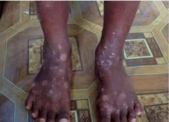 Detectan en Haití infección altamente contagiosa por contacto de la piel