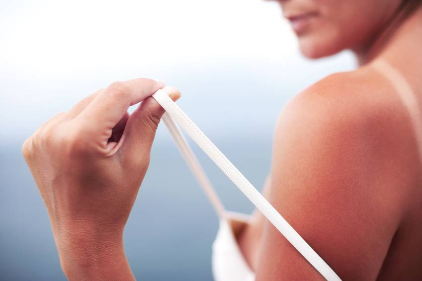 Alrededor del 90 % de casos de cáncer de piel se asocian a exposición al sol