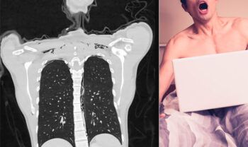 Joven se desgarró un pulmón mientras se auto complacía