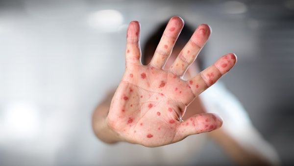 EE.UU. reporta por primera vez dos casos de viruela del mono en niños