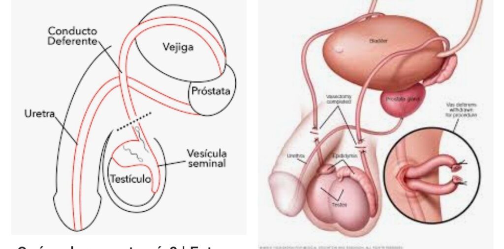 Vasectomías. ¿Por qué crece esta práctica entre varones y en qué casos dispara controversia?