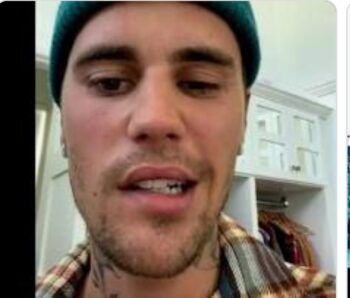 Justin Bieber sufre parálisis facial 