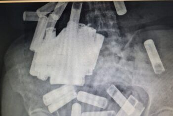 Le extrajeron 55 pilas AA y AAA del estómago