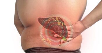 Encuentran un fármaco prometedor para el tratamiento del hígado graso