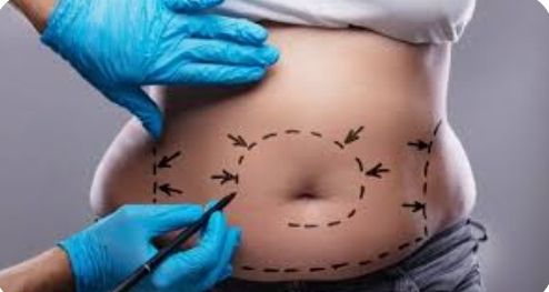 Mujer finje cáncer terminal para recolectar dinero para una lipo