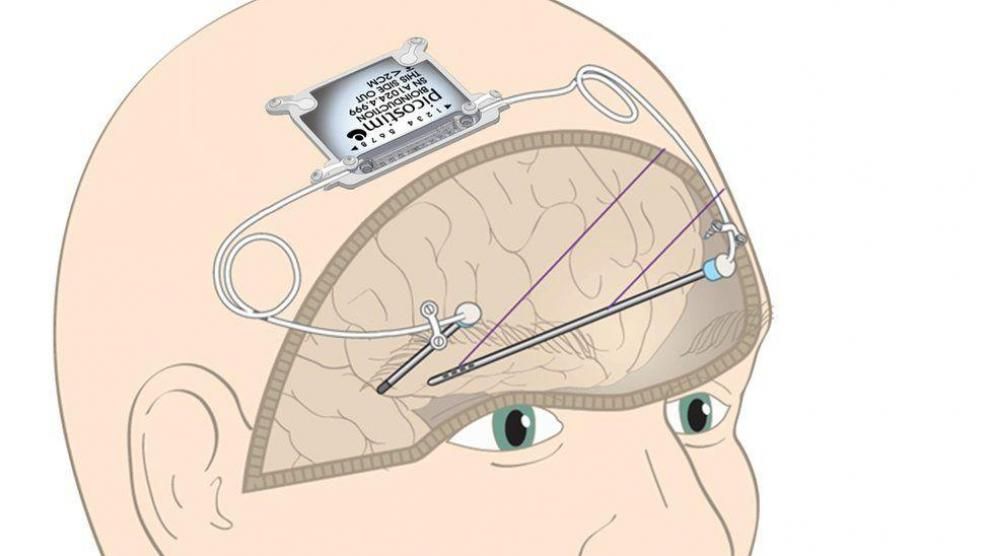 Un implante cerebral podría revertir los síntomas del párkinson