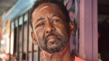 Hombre casi pierde un ojo al ser atacado por un Pitbull