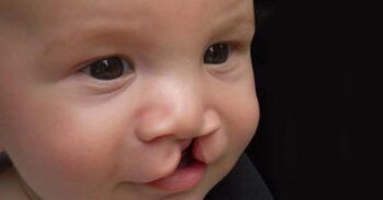 Anuncian jornada de cirugía en hospital Padre Billini