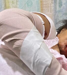 Mujer es atacada por dos perros pitbull en Santiago