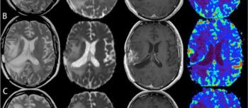 La curación de un niño con tumor cerebral llena de optimismo a los científicos
