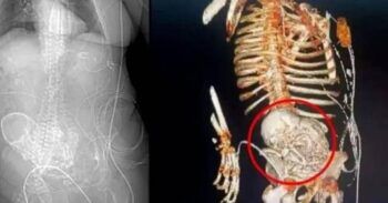 Muere mujer que llevó en su vientre un feto calcificado por 40 años