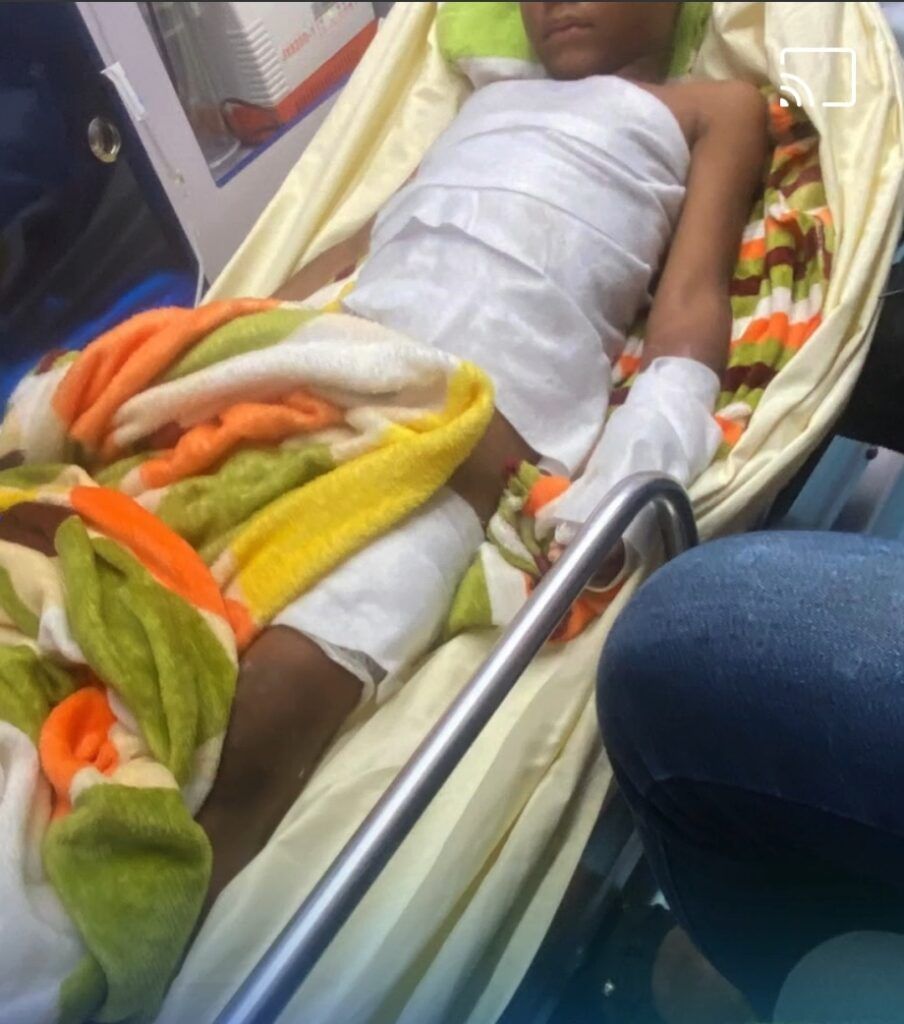 Niño de 5 años cae en cardero de habichuela con dulce caliente