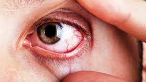 Ceguera por glaucoma puede evitarse en mayoría de los casos