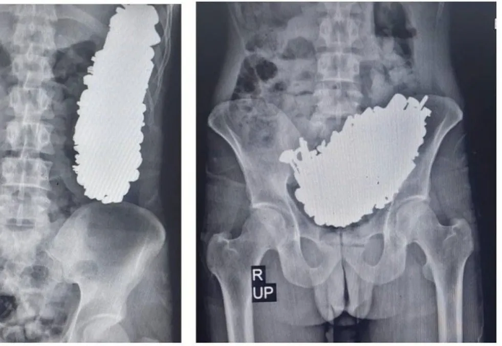 Fue al médico con un dolor abdominal y resultó con más de 400 objetos de metal en el estómago