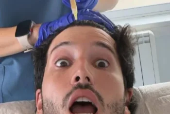 Sebastián Yatra se realiza transplante de pelo