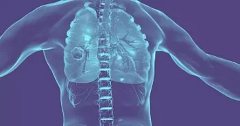 Creía tener cáncer de pulmón, pero descubren que era un juguete atorado